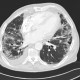 Lung fibrosis, pneumonia, pleural effusion: CT - Computed tomography